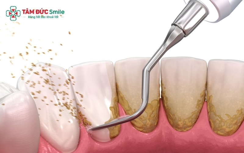 Tuyệt đối không tự dùng vật nhọn cạy vôi răng tại nhà vì rất dễ làm trầy xước men răng và gây nhiễm trùng nướu sâu.