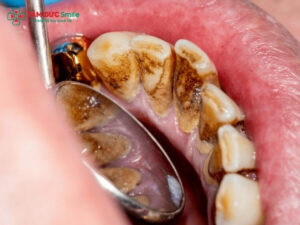 Vôi răng bị vỡ: Cao răng tự bong, hôi miệng, viêm nướu cần xử lý