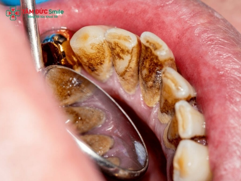 Vôi răng bị vỡ: Cao răng tự bong, hôi miệng, viêm nướu cần xử lý